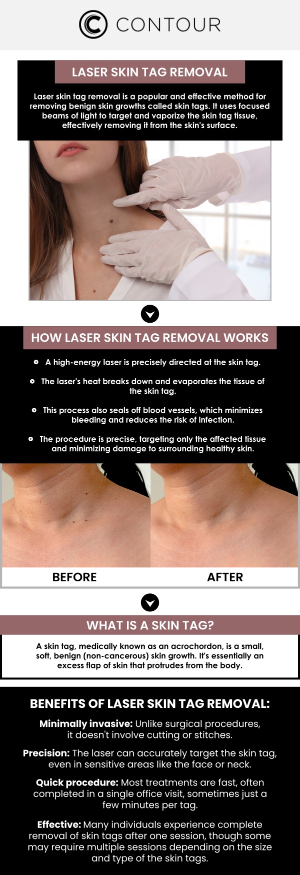 Laser skin tag removal at Contour Medical Spa provides an effective, minimally invasive solution for removing skin tags with precision. Using advanced laser technology, the procedure targets the skin tags without causing damage to surrounding areas. It’s a quick treatment with minimal downtime, allowing you to resume daily activities almost immediately. Enjoy smooth, clear skin with the expertise and care of Contour Medical Spa. For more information, contact us today or request a consultation. Our medspa is conveniently located at 18641 Devonshire Street Northridge, CA 91324. Laser skin tag removal at Contour Medical Spa provides an effective, minimally invasive solution for removing skin tags with precision. Using advanced laser technology, the procedure targets the skin tags without causing damage to surrounding areas. It’s a quick treatment with minimal downtime, allowing you to resume daily activities almost immediately. Enjoy smooth, clear skin with the expertise and care of Contour Medical Spa. For more information, contact us today or request a consultation. Our medspa is conveniently located at 18641 Devonshire Street Northridge, CA 91324.