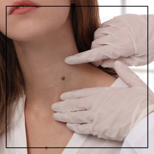 Laser Skin Tag Removal Near Me in Northridge, Los Angeles, CA