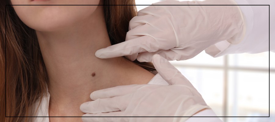 Laser Skin Tag Removal Specialist Near Me in Northridge, Los Angeles, CA Laser Skin Tag Removal Specialist Near Me in Northridge, Los Angeles, CA