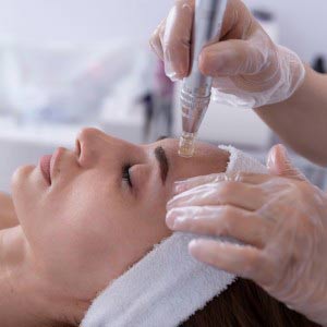 SkinPen Microneedling Specialist Near Me in Northridge, Los Angeles, CA