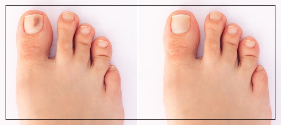 Toenail Fungus Laser Removal Specialist Near Me in Northridge, Los Angeles, CA Toenail Fungus Laser Removal Specialist Near Me in Northridge, Los Angeles, CA