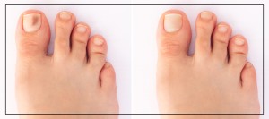Toenail Fungus Laser Removal Specialist Near Me in Northridge, Los Angeles, CA Toenail Fungus Laser Removal Specialist Near Me in Northridge, Los Angeles, CA