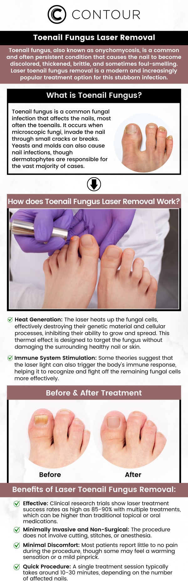 Toenail fungus laser removal at Contour Medical Spa offers a safe and effective solution for treating stubborn toenail fungus. Using advanced laser technology, the procedure targets the fungus directly, promoting healing and new nail growth. The treatment is virtually painless and requires no downtime, allowing you to return to your normal activities quickly. Experience fast and lasting results with professional care at Contour Medical Spa. For more information, contact us today or request a consultation. Our medspa is conveniently located at 18641 Devonshire Street Northridge, CA 91324. Toenail fungus laser removal at Contour Medical Spa offers a safe and effective solution for treating stubborn toenail fungus. Using advanced laser technology, the procedure targets the fungus directly, promoting healing and new nail growth. The treatment is virtually painless and requires no downtime, allowing you to return to your normal activities quickly. Experience fast and lasting results with professional care at Contour Medical Spa. For more information, contact us today or request a consultation. Our medspa is conveniently located at 18641 Devonshire Street Northridge, CA 91324.
