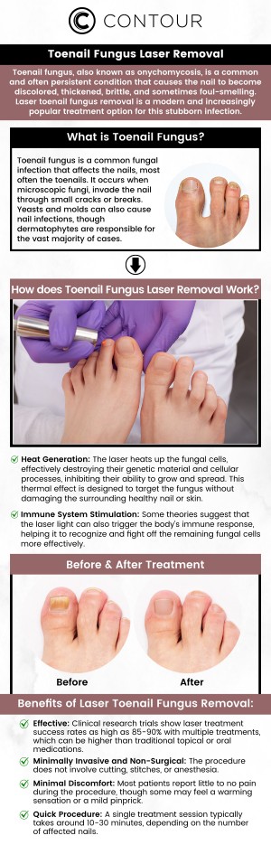 Toenail fungus laser removal at Contour Medical Spa offers a safe and effective solution for treating stubborn toenail fungus. Using advanced laser technology, the procedure targets the fungus directly, promoting healing and new nail growth. The treatment is virtually painless and requires no downtime, allowing you to return to your normal activities quickly. Experience fast and lasting results with professional care at Contour Medical Spa. For more information, contact us today or request a consultation. Our medspa is conveniently located at 18641 Devonshire Street Northridge, CA 91324. Toenail fungus laser removal at Contour Medical Spa offers a safe and effective solution for treating stubborn toenail fungus. Using advanced laser technology, the procedure targets the fungus directly, promoting healing and new nail growth. The treatment is virtually painless and requires no downtime, allowing you to return to your normal activities quickly. Experience fast and lasting results with professional care at Contour Medical Spa. For more information, contact us today or request a consultation. Our medspa is conveniently located at 18641 Devonshire Street Northridge, CA 91324.