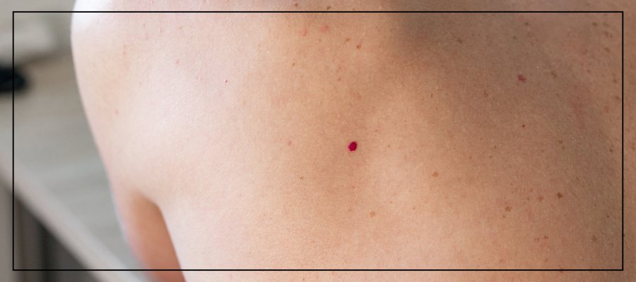 Cherry Angioma Removal Treatment Near Me In Northridge, Los Angeles, CA