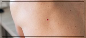 Cherry Angioma Removal Treatment Near Me In Northridge, Los Angeles, CA