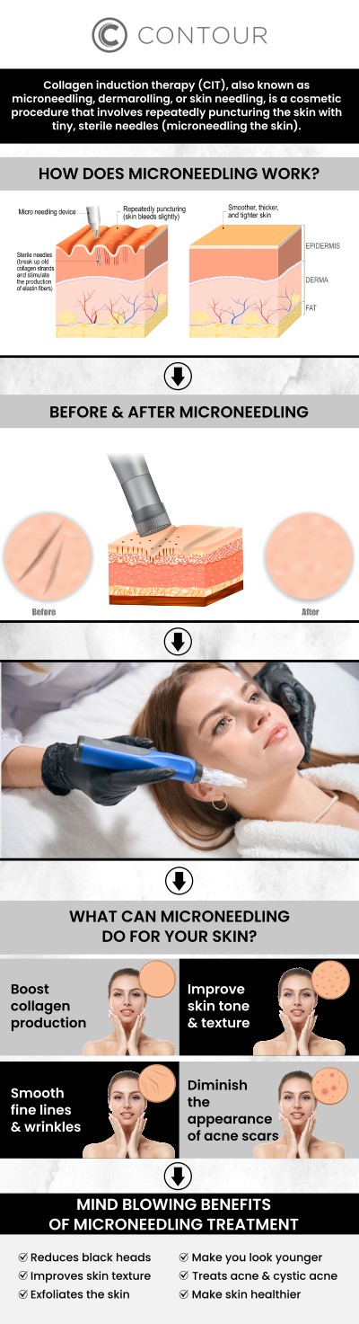 At Contour Medical Spa in Northridge, Los Angeles, we specialize in SkinPen Microneedling, an FDA-cleared, medical-grade microneedling device designed to improve the texture and appearance of your skin. Led by Cecilia Scott, RN, BSN, our SkinPen treatment stimulates collagen production, helping to reduce fine lines, acne scars, and enlarged pores, while leaving your skin smoother, firmer, and more radiant. Cecilia provides personalized, professional care tailored to your skin’s unique needs, ensuring an effective and comfortable experience. Whether you’re seeking rejuvenation or addressing specific skin concerns, SkinPen Microneedling offers a trusted solution for a refreshed, youthful glow.  Contact us today for more information or request a consultation. We are conveniently located at 18641 Devonshire Street Northridge, CA 91324.