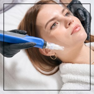 SkinPen Microneedling Near Me in Northridge, Los Angeles, CA