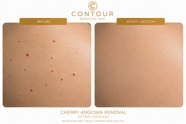 Before and After Cherry Angiomas Treatment Specialist in Northridge, Los Angeles, CA Before and After Cherry Angiomas Treatment Specialist in Northridge, Los Angeles, CA
