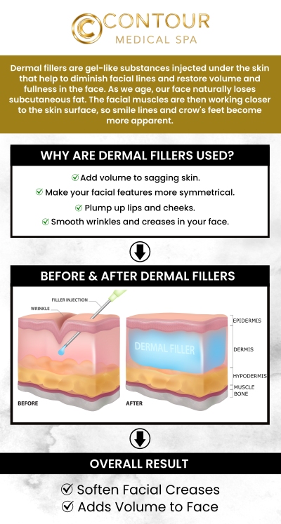 Dermal fillers are used to treat fine lines and deep wrinkles, lessen scars and skin depression, and minimize the effects of aging. Our experienced team at Contour Medical Spa offers dermal fillers (Juvederm), a non-surgical, safe, and effective method to restore a more youthful and revitalized appearance. For more information, contact us or book an appointment online. We are conveniently located at 18641 Devonshire Street Northridge, CA 91324. Dermal fillers are used to treat fine lines and deep wrinkles, lessen scars and skin depression, and minimize the effects of aging. Our experienced team at Contour Medical Spa offers dermal fillers (Juvederm), a non-surgical, safe, and effective method to restore a more youthful and revitalized appearance. For more information, contact us or book an appointment online. We are conveniently located at 18641 Devonshire Street Northridge, CA 91324.