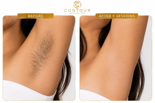 Laser Hair Removal Before and After in Northridge, Los Angeles, CA