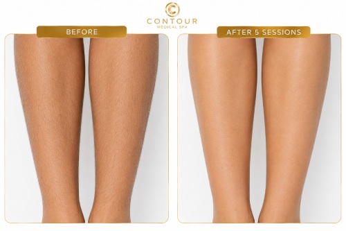 Laser Hair Removal Before and After in Northridge, Los Angeles, CA
