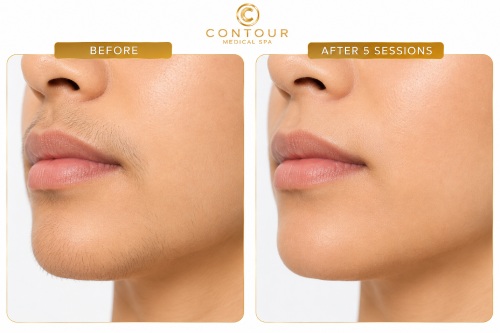 Laser Hair Removal Before and After in Northridge, Los Angeles, CA