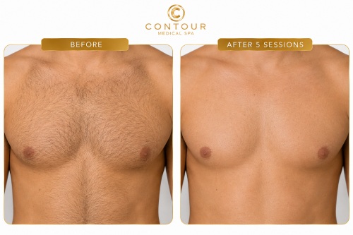 Laser Hair Removal Before and After in Northridge, Los Angeles, CA