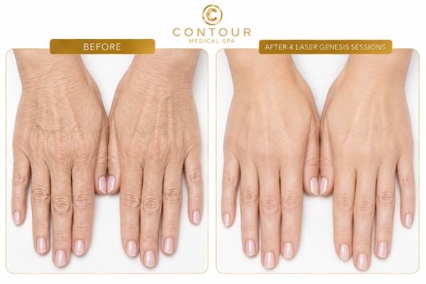 Laser Hand Rejuvenation Treatment Before and After in Northridge, Los Angeles, CA