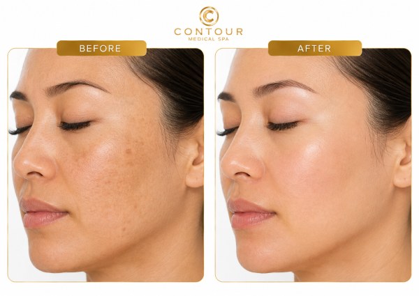 Laser Peels Before and After in Northridge, Los Angeles, CA Laser Peels Before and After in Northridge, Los Angeles, CA
