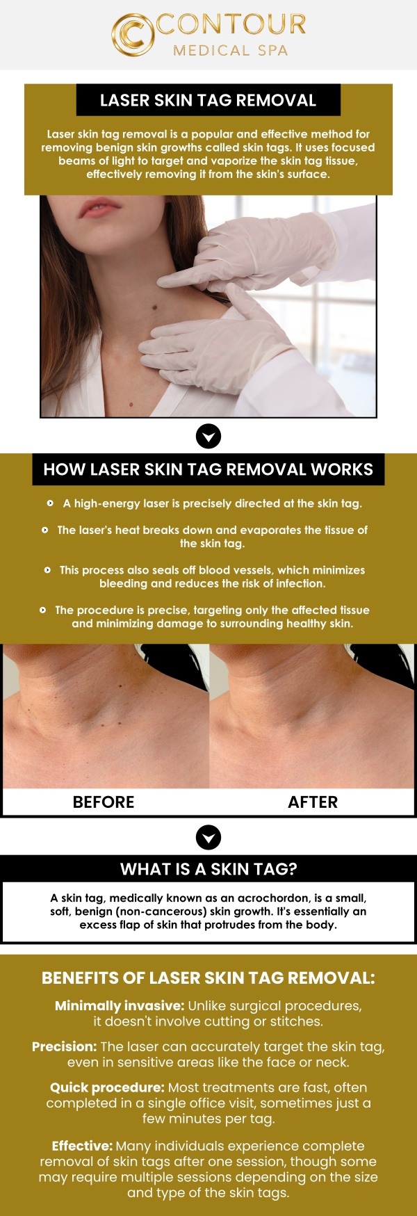 Skin tags are benign growths that commonly develop in areas where skin rubs against skin or clothing. At Contour Medical Spa, Cecilia Scott, RN, BSN, provides non-invasive skin tag removal using advanced Cutera YAG 1064 laser technology. The laser precisely targets unwanted skin tag tissue without surgical cutting or harsh chemicals, helping minimise discomfort and downtime. Whether the skin tags are causing irritation or affecting the appearance of your skin, Cecilia personalises each treatment to support smooth, clear-looking results and a comfortable recovery. For more information, contact us or schedule an appointment online. Our med spa is conveniently located at 18641 Devonshire Street Northridge, CA 91324.
