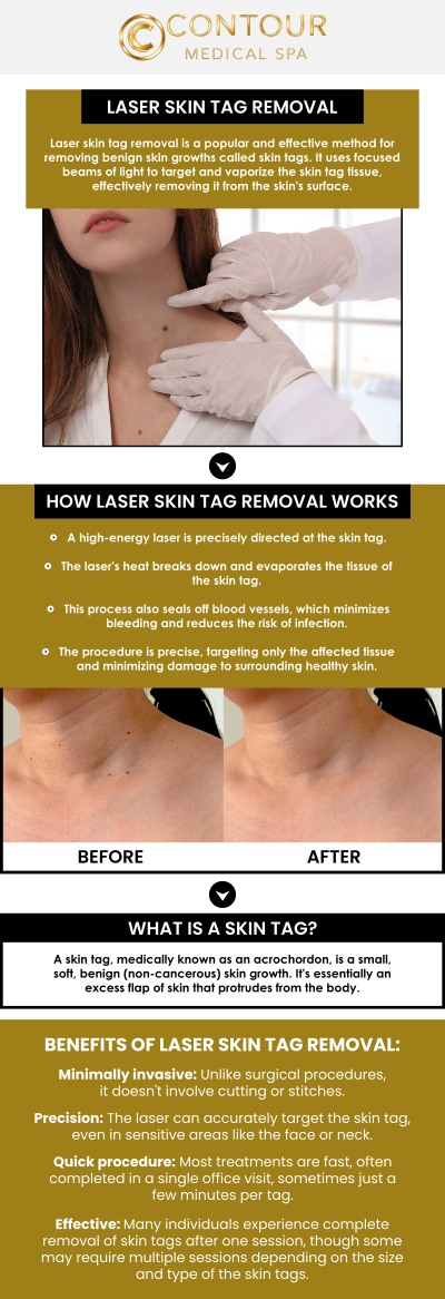 Skin tags are benign growths that commonly develop in areas where skin rubs against skin or clothing. At Contour Medical Spa, Cecilia Scott, RN, BSN, provides non-invasive skin tag removal using advanced Cutera YAG 1064 laser technology. The laser precisely targets unwanted skin tag tissue without surgical cutting or harsh chemicals, helping minimise discomfort and downtime. Whether the skin tags are causing irritation or affecting the appearance of your skin, Cecilia personalises each treatment to support smooth, clear-looking results and a comfortable recovery. For more information, contact us or schedule an appointment online. Our med spa is conveniently located at 18641 Devonshire Street Northridge, CA 91324.
