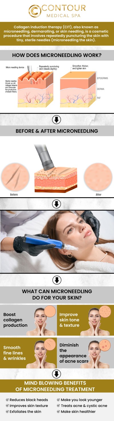 Our microneedling treatment at Contour Medical Spa in Northridge, Los Angeles, CA, is tailored to address a variety of skin concerns, including fine lines, wrinkles, acne scars, and uneven texture. By stimulating natural collagen and elastin production, our skilled team helps clients achieve smoother, firmer, and more radiant skin. Each session is customized to your skin type and goals, ensuring safe, effective, and long-lasting results. For more information, contact us today or request an appointment online. We are conveniently located at 18641 Devonshire Street, Northridge, CA 91324.