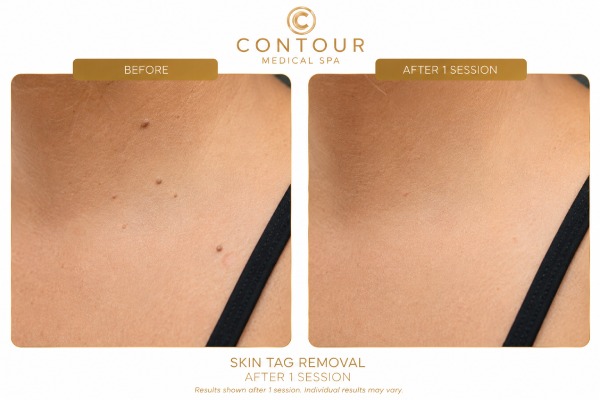 Laser Skin Tag Removal Before And After in Northridge, Los Angeles, CA