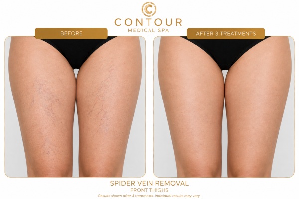 Laser Treatment for Spider Veins & Facial Capillaries Before and After in Northridge, Los Angeles, CA