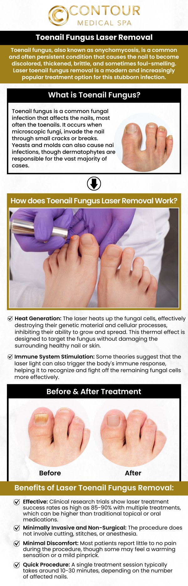 Toenail fungus laser removal at Contour Medical Spa offers a safe and effective solution for treating stubborn toenail fungus. Using advanced laser technology, the procedure targets the fungus directly, promoting healing and new nail growth. The treatment is virtually painless and requires no downtime, allowing you to return to your normal activities quickly. Experience fast and lasting results with professional care at Contour Medical Spa. For more information, contact us today or request a consultation. Our medspa is conveniently located at 18641 Devonshire Street Northridge, CA 91324.