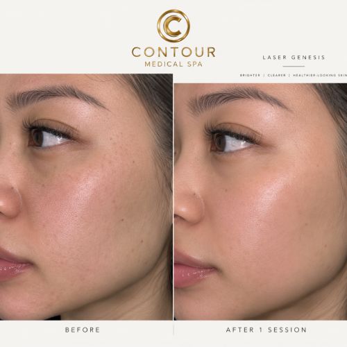 Laser Genesis Specialist in Northridge, Los Angeles, CA
